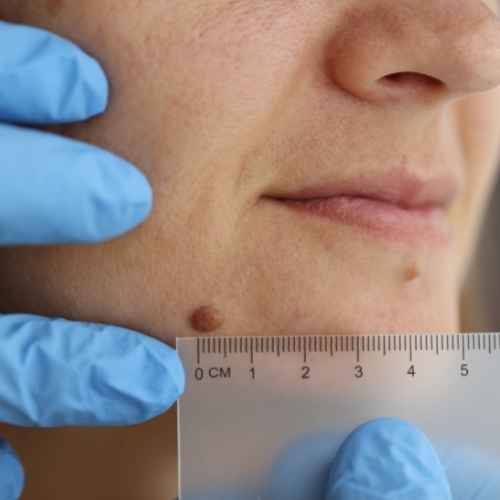 CryoPen Basingstoke  - Blemish Removal