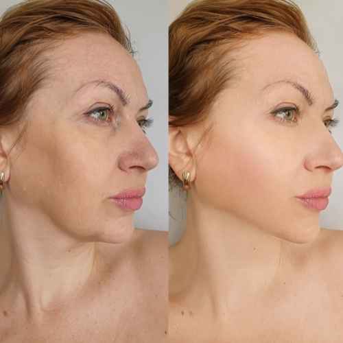 HIFU Non Surgical Facelift Basingstoke 