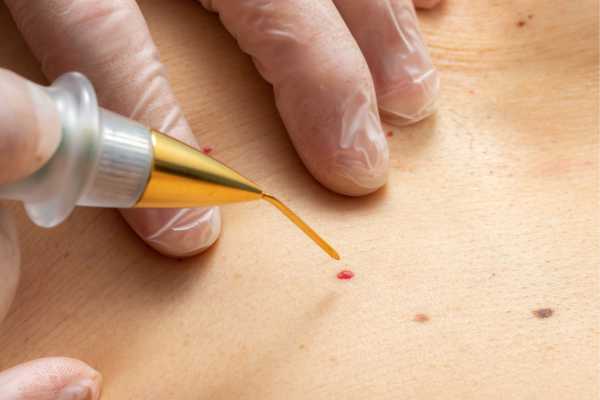 Cherry Angioma Removal Basingstoke 