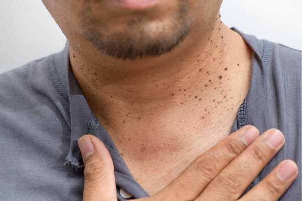 How Does Skin Tag Removal Basingstoke  Work?