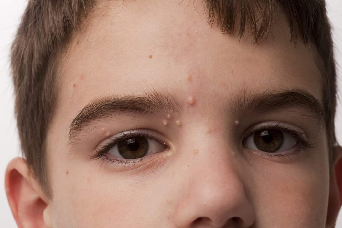 Molluscum Contagiosum Basingstoke , How We Remove It