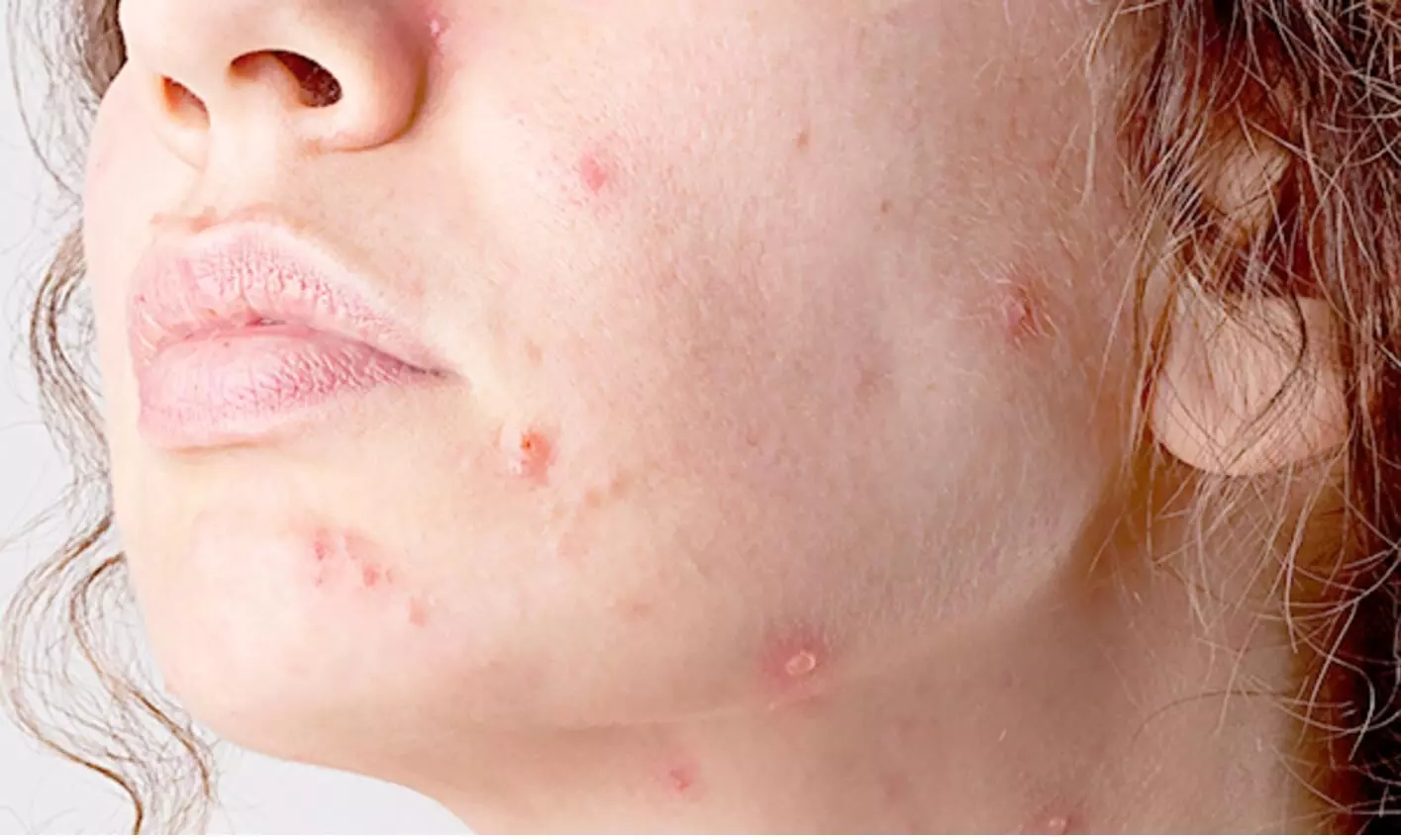 Porokeratosis Basingstoke , How We Remove It