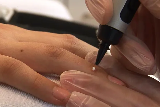 Porokeratosis Treatment Basingstoke 