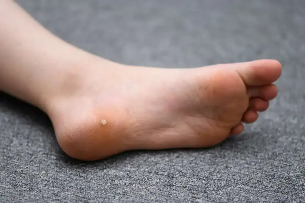 Image of verruca on the bottom of the foot that able to be treated with Cryotherapy Basingstoke 