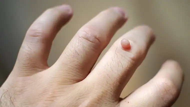 Image of blemish that Cryotherapy Basingstoke  can remove with Lipo 360.