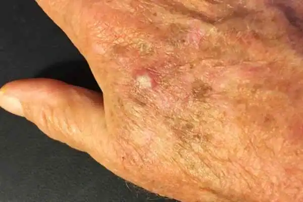 Image of Actinic keratoses Basingstoke  on a person hand