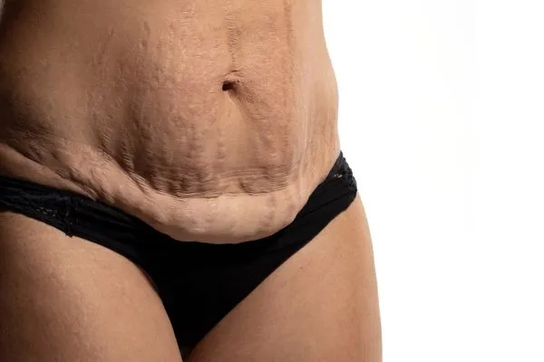 The science behind skin tightening Basingstoke  picture of a woman's sagging skin on the stomach