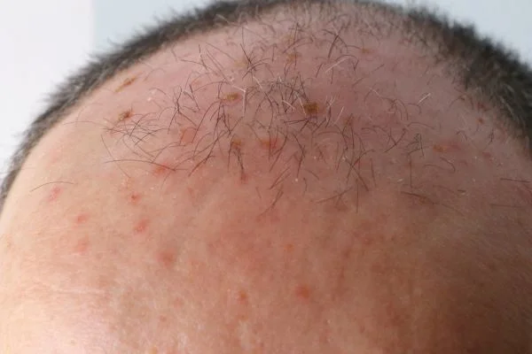 Actinic Keratoses Basingstoke 