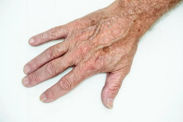 age spot removal Basingstoke 