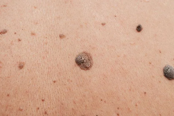 Benign Moles Basingstoke 