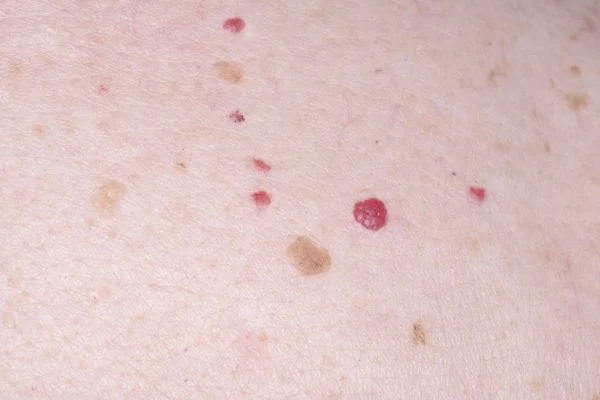 Cherry Angiomas Basingstoke 