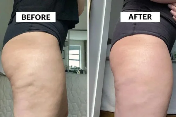 Body Sculpting Results Basingstoke 