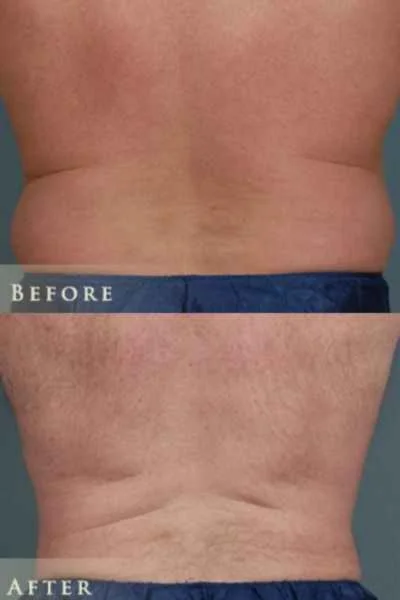 fat freezing results love handles