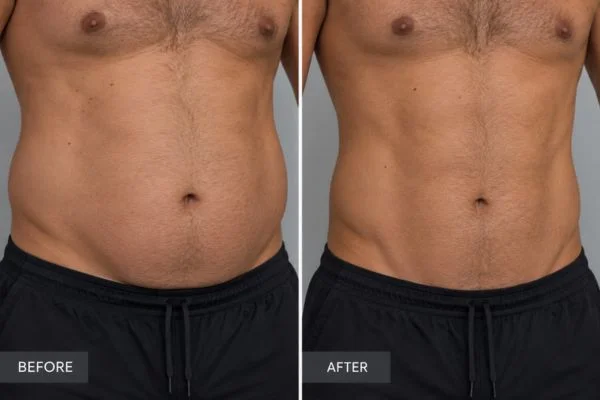Body sculpting results Basingstoke 