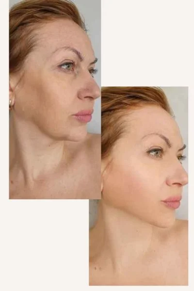 HIFU Results Basingstoke  before and after