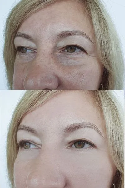collagen lift 360 results Basingstoke 