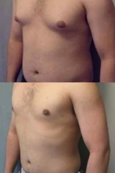 Cryolipolysis fat freezing results {Name)