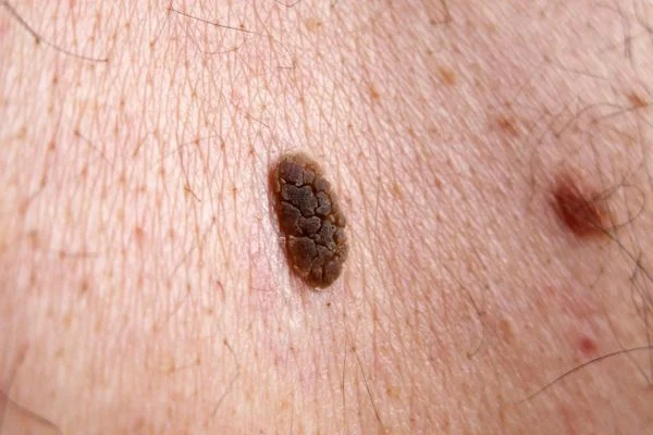 Seborrhoeic Keratoses removal Basingstoke 