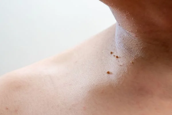 skin tag removal Basingstoke 